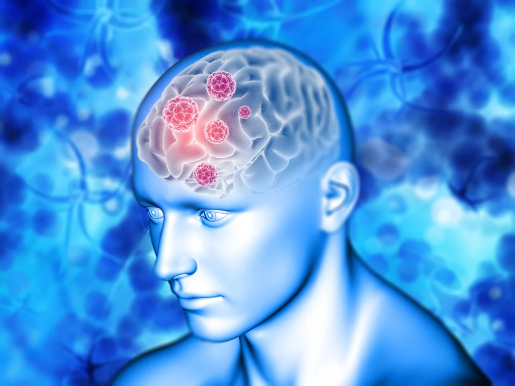 What is a Brain Tumor? - brain tumor symptoms What is a Brain Tumor? - brain tumor symptoms