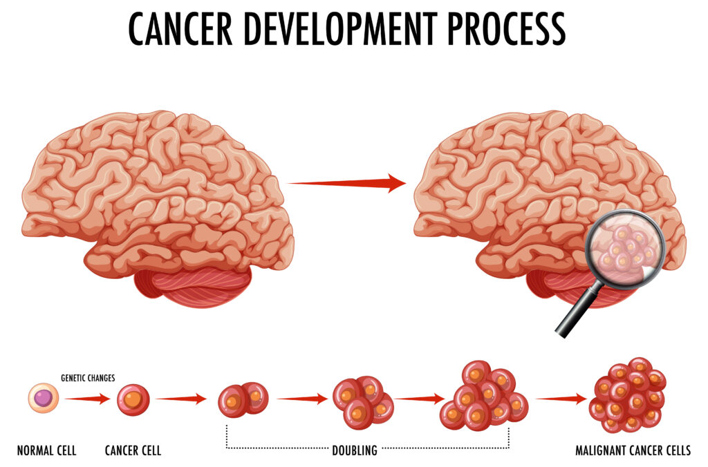 Common Early Symptoms - brain cancer symptoms Common Early Symptoms - brain cancer symptoms